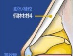 假体隆鼻后假体取出的情况及鼻子变形问题探讨